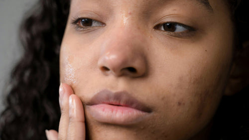 Unsere Top-Tipps für zu Akne neigende Haut