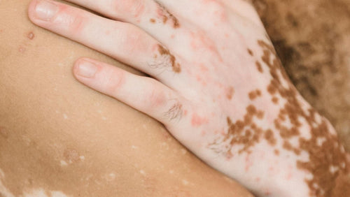 Was Sie nicht über Vitiligo wussten